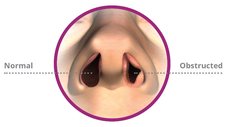 TMJ VivAer Treatment in Phoenix