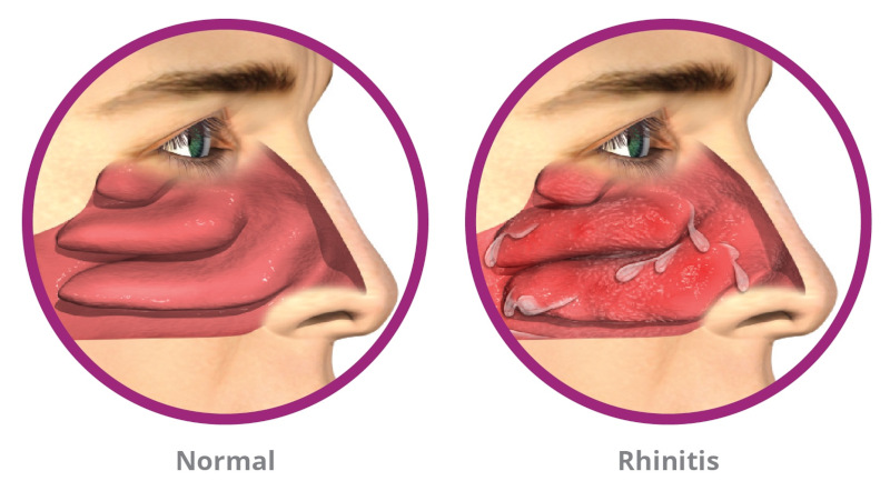 TMJ RhinAer Treatment in Phoenix
