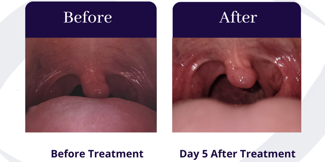 Before & After QuietNite Treatment